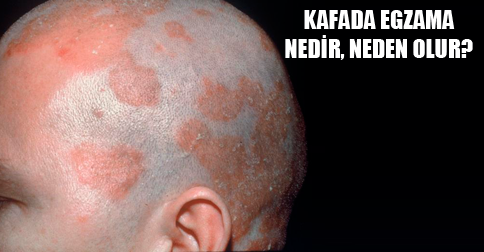 kafada-seboreik-dermatit